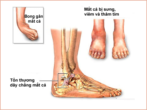Tìm hiểu về lật cổ chân (lật sơ mi cổ chân)
